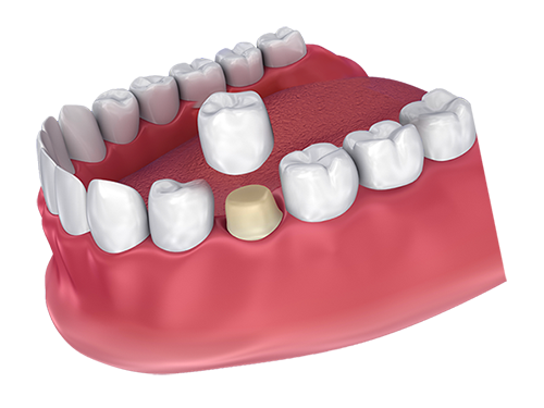 dental-crowns-in-bangalore
